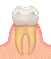 歯周病の進行：健康な状態
