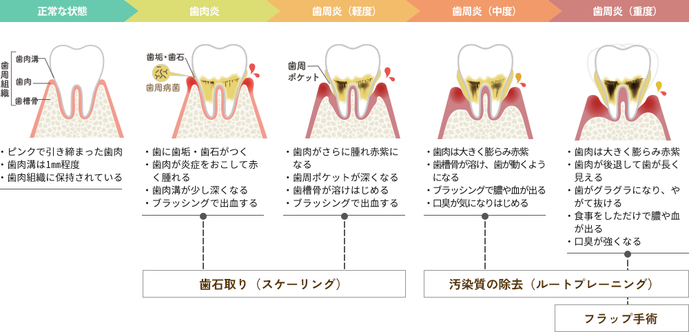 歯周病の進行と治療法