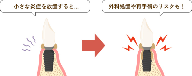 小さな炎症を放置すると外科処置や再手術のリスクも